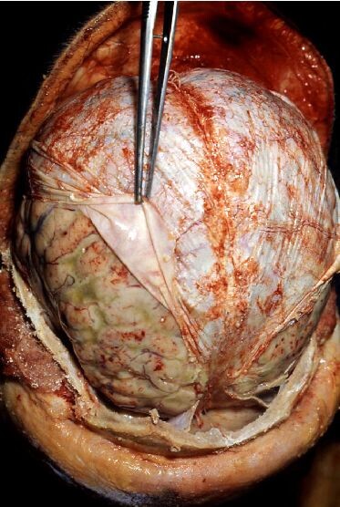 hersenobductie